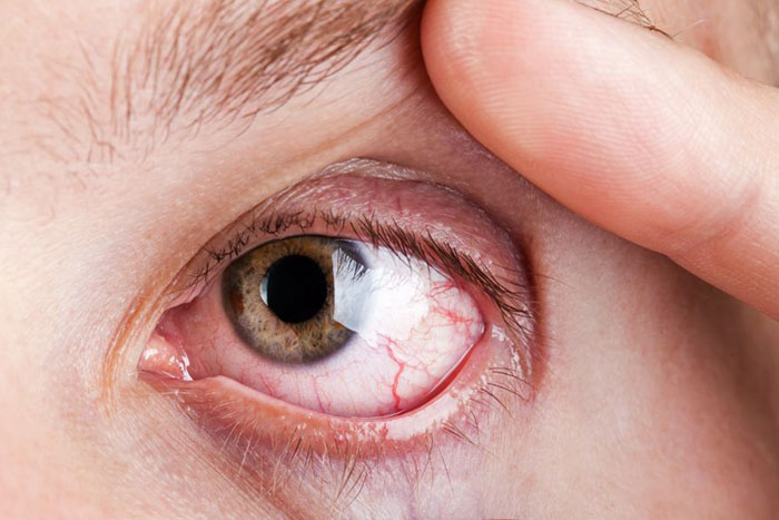 Retinal Vein Occlusion: Causes, Types & Treatment