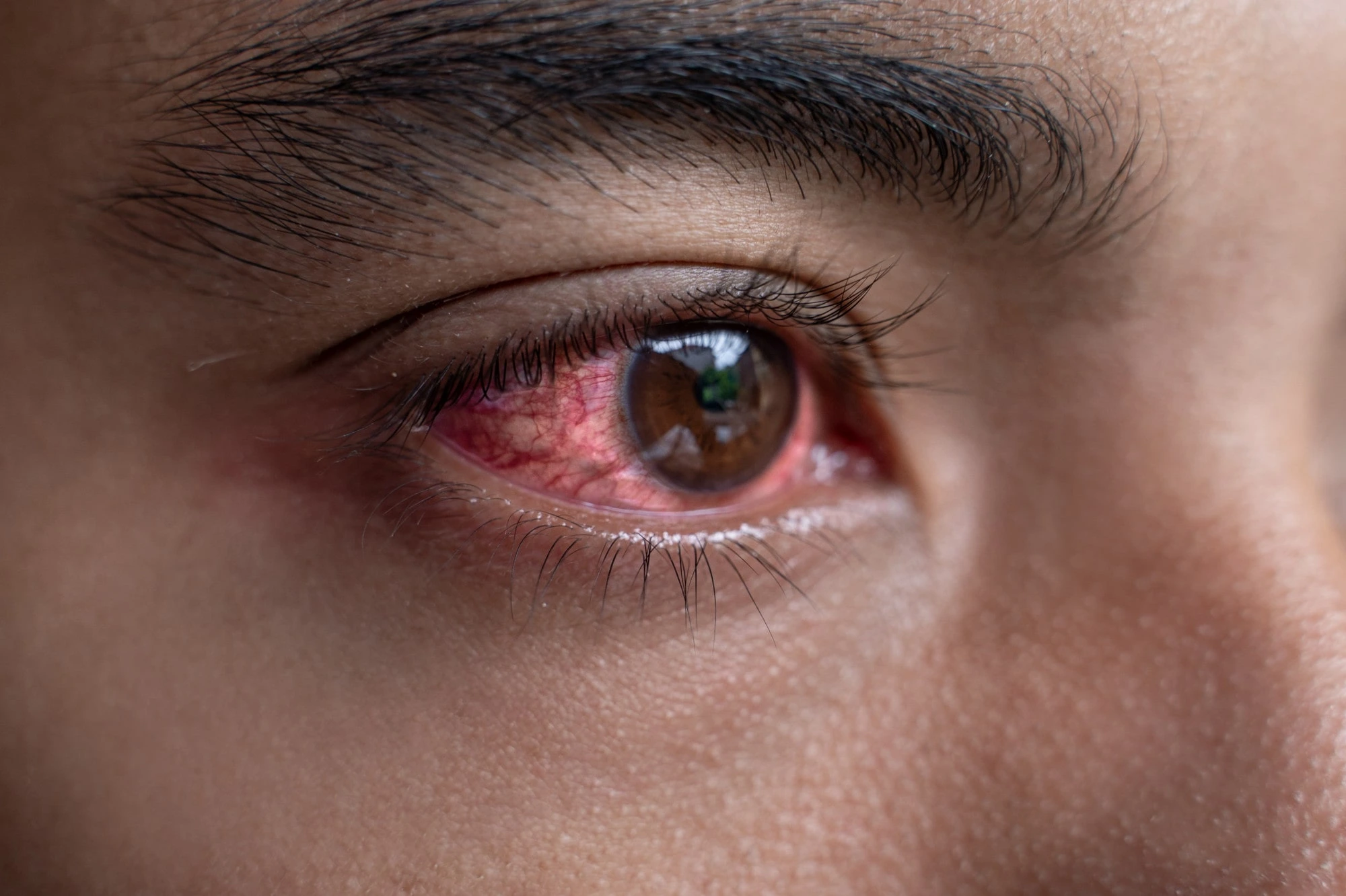 Red Eyes, Pain, or Discharge? When It’s More Than Just Irritation