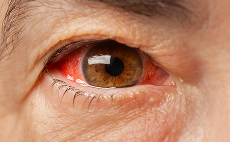 How Glaucoma Develops Silently and What to Do About It