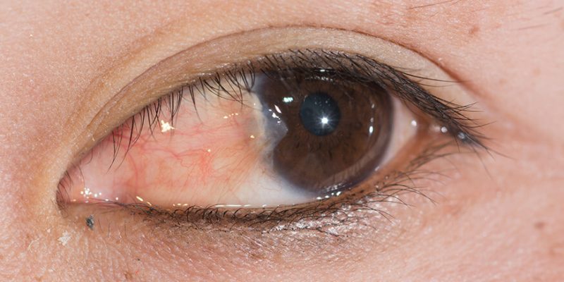 Pterygium Surgery Pterygium Surgery